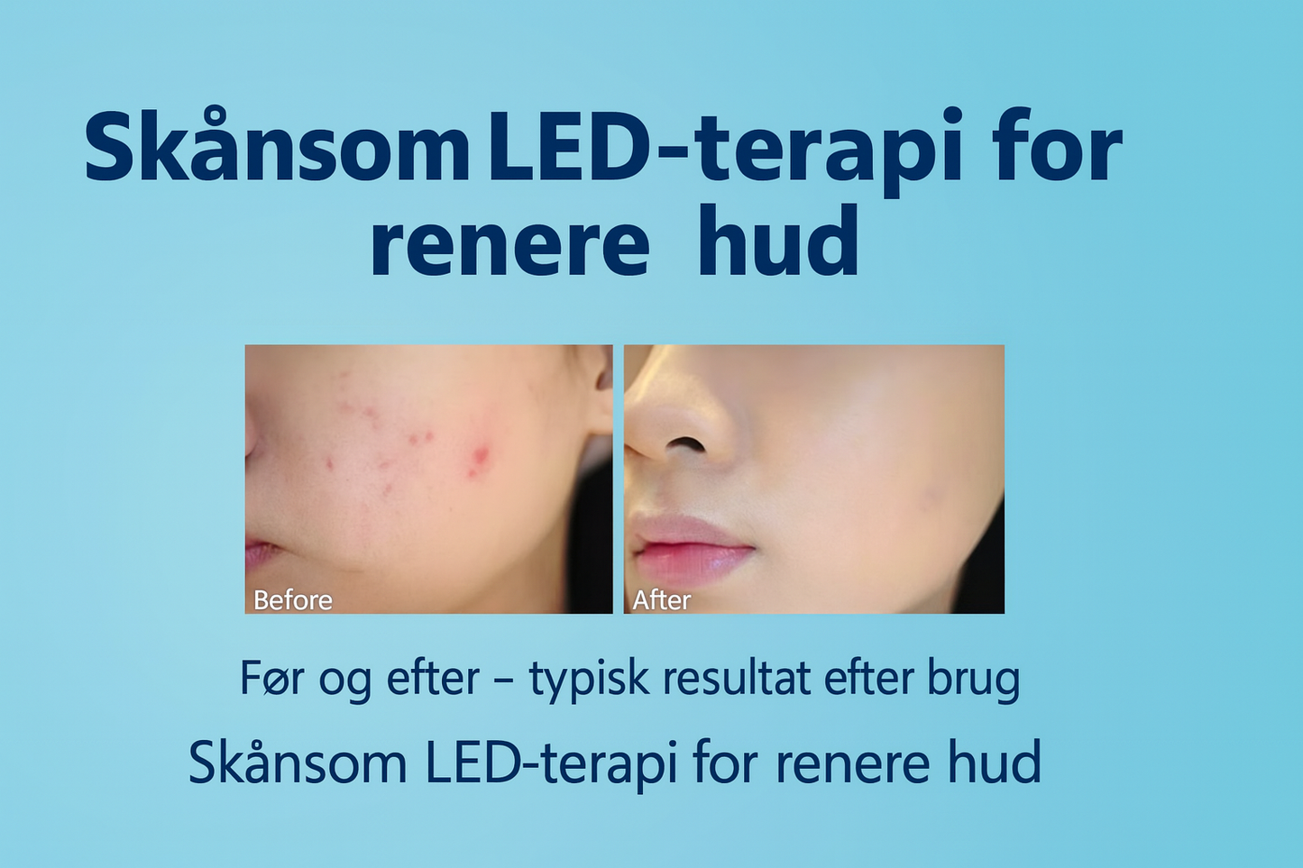 Blue Light Therapy Acne Pen – Effektiv mod uren hud