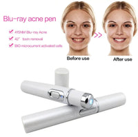 Blue Light Therapy Acne Pen – Effektiv mod uren hud