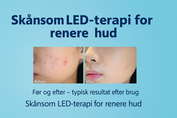 Blue Light Therapy Acne Pen – Effektiv mod uren hud